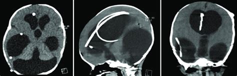 Non Contrast Computed Tomography Scan Axial Sagittal And Coronal