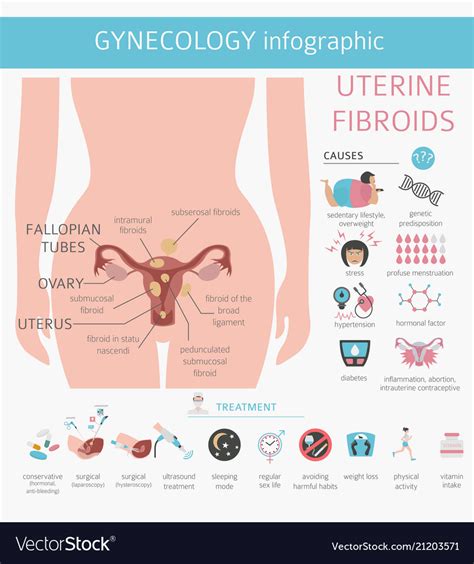 Uterine Fibroids Ginecological Medical Desease Vector Image