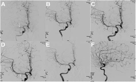 Frontiers Safety And Efficacy Of Endovascular Recanalization For