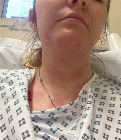 Woman Suffering Anaphylaxis Credits App With Saving Her Life