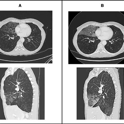 Screening Ct Scan Showing Ground Glass Opacities Ggos In Middle Lobe Download Scientific