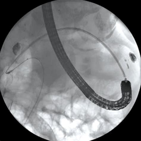 Duodenal Stent