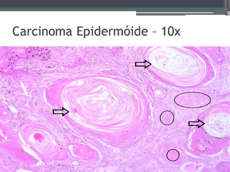 Lâminas Carcinoma Basocelular E Epidermoide Youtube