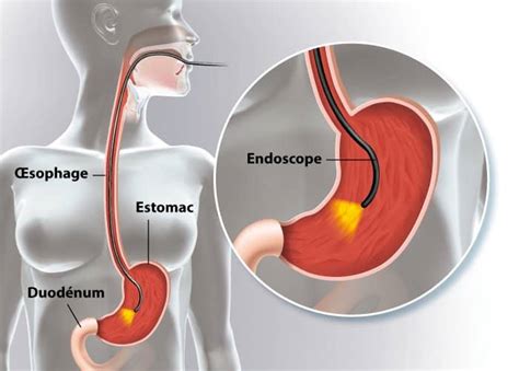 Déroulement De La Fibroscopie Gastrique Lifestyle Mag