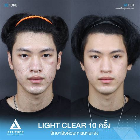 รีวิว Attitude Clinic ห้วยขวาง รักษาสิวครบวงจร โปรแกรม Light Clear