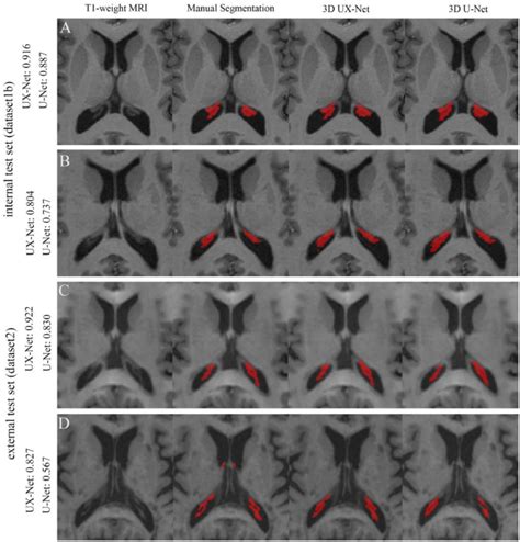 Enhanced Choroid Plexus Segmentation With 3D UX Net And Its Association