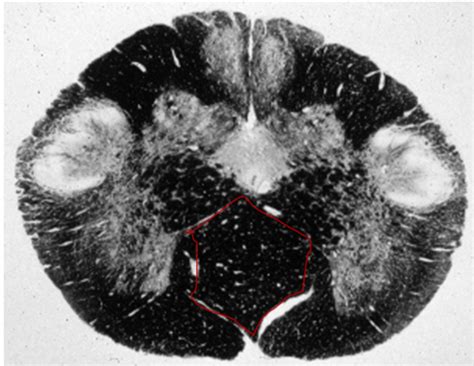 Brainstem Cross Sectionsv Flashcards Quizlet