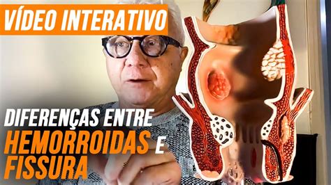 Saibam A Diferença Hemorroida E Fissura Na Peça Anatomia Forma