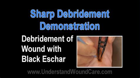 Sharp Debridement | Vohra Wound Physicians