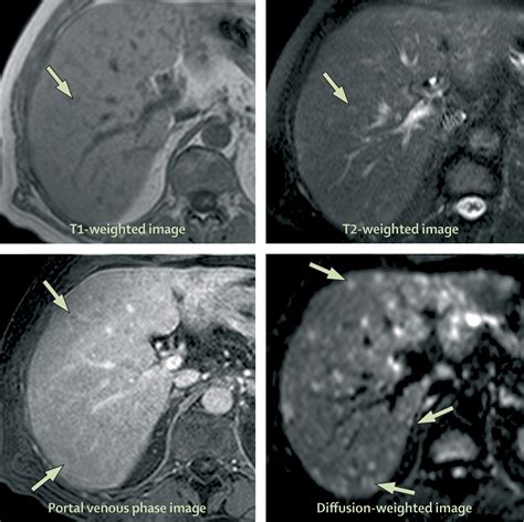 Abdominal Mri Advances In The Detection Of Liver Tumours And Characterisation The Lancet Oncology