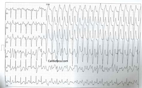 Curso Ecg Taquicardia Sinusal Con Bloqueo De Rama Izquierda Frecuencia