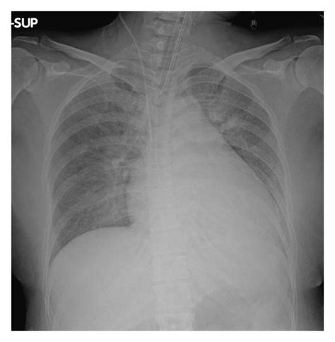 Chest X Ray On Admission Showing Bilateral Pulmonary Infiltration And