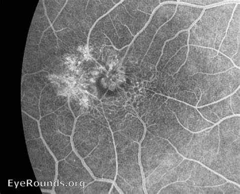 Juxtafoveal Telangiectasia Eyerounds Org Online Ophthalmic Atlas