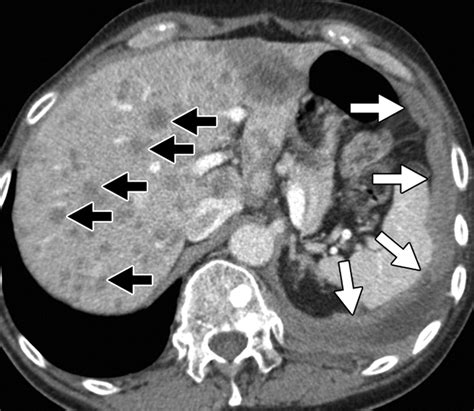 Solid Pleural Lesions Ajr