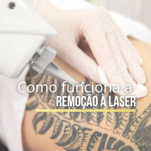 Como Funciona A Remo O De Tatuagem A Laser Ak Clinic Beauty