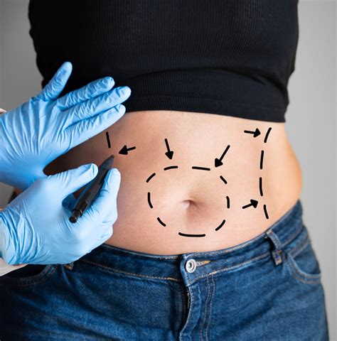 Tummy Tuck Turkey Abdominoplasty