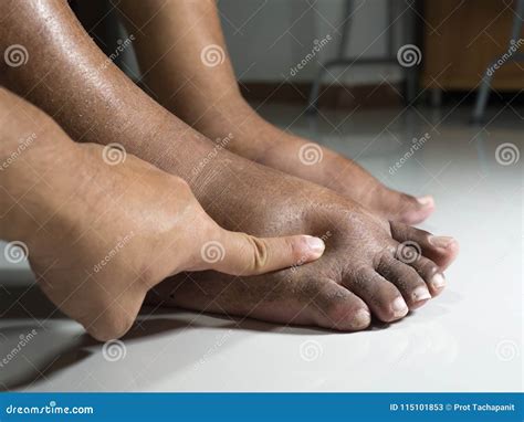 The Feet Of People With Diabetes Dull And Swollen Due To The Toxicity