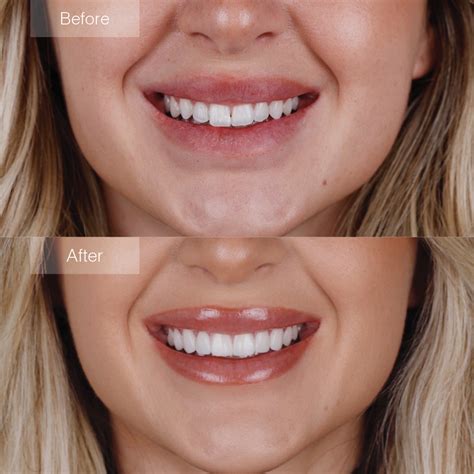 Porcelain Veneers Before And After The Dental Room