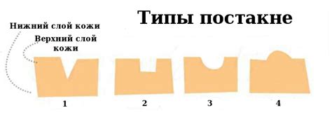 Постакне