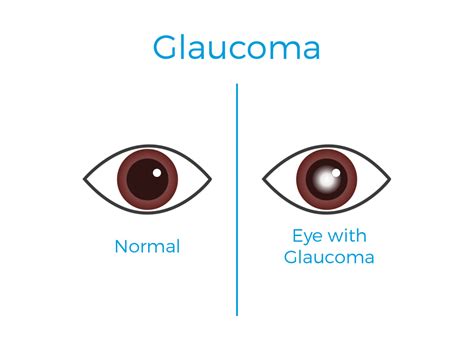 Best glaucoma treatment and surgery in Europe | Betamedics