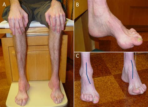 Charcot Marie Tooth Disease And Other Hereditary Neuropathie