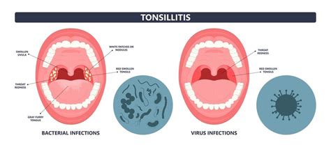 Uvula Infection Symptoms