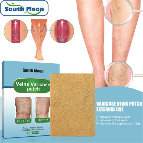 Varicose Veins Treatment For Legs Varicose Veins Patch Relief Leg