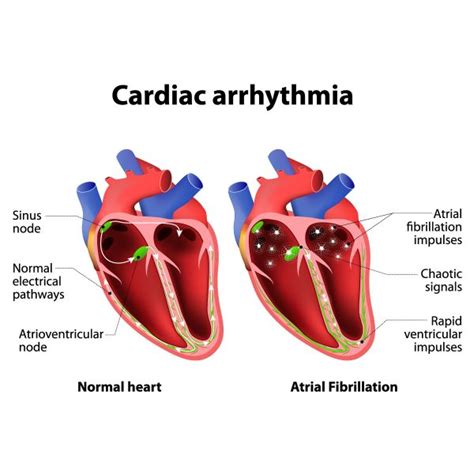 How Serious Is Heart Arrhythmia Learn More Vejthani