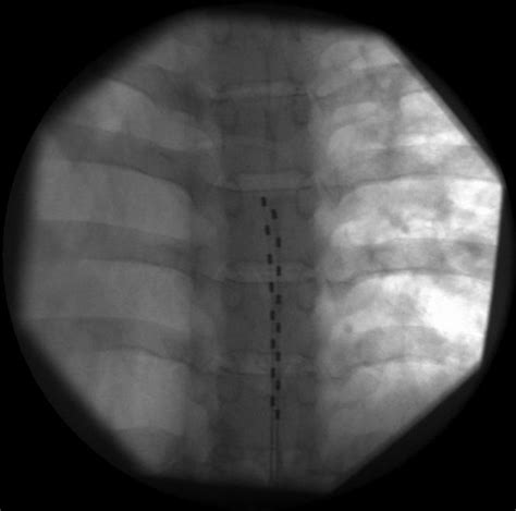 Thoracic Epidural Placement Of Two Eight Electrode Epidural Leads Download Scientific Diagram