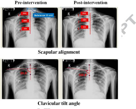 Figure 4 from Effects of scapular upward rotation exercises on ...