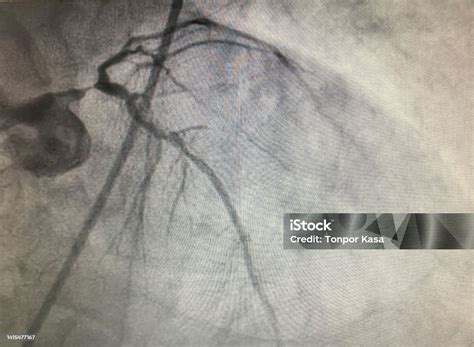 coronary artery disease tripple vessle disease  left main severe