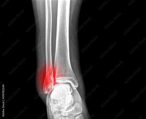 x-ray of ankle fracture Stock Photo | Adobe Stock