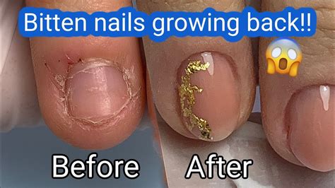 How To Fix Short Bitten Nails With Gel At Edward Macmillan Blog