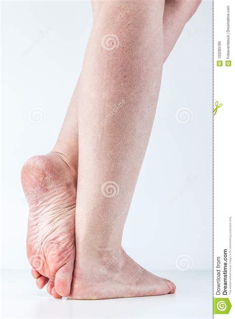 Dehydrated Skin Female Heels Stock Image Image Of Heel Dermatology