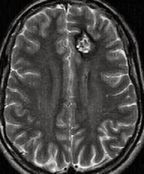 Ultimate Radiology : Multiple Cavernomas in Brain