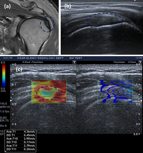 a MRI coronal oblique STIR images of supraspinatus tendon showing ...