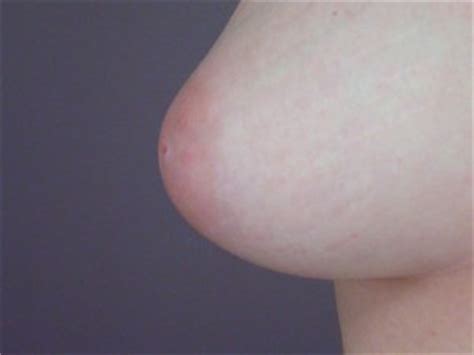 Los Angeles Nipple Inversion Correction Before And After Photos