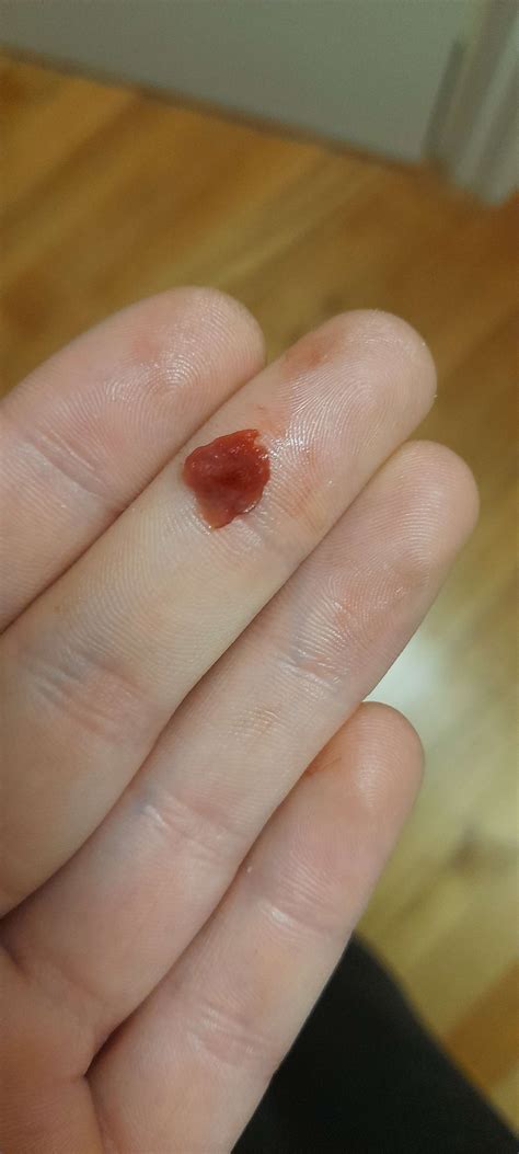 gum fell out of my mouth after a nap : r/wisdomteeth