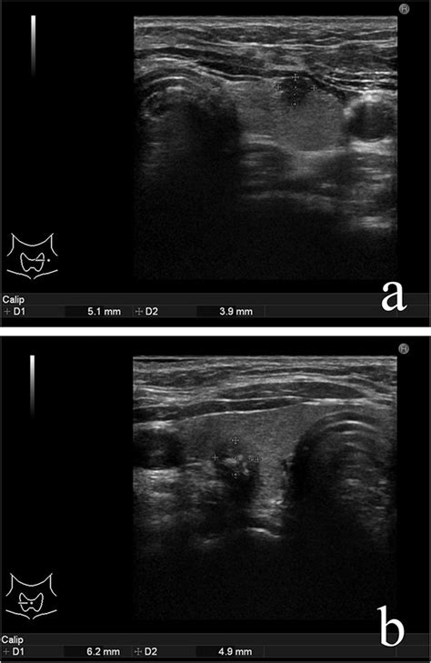 A Us Findings Shown For The Left Lobe Of The Thyroid Gland B Us