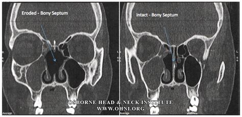 Wegeners Granulomatosis Autoimmune Disease And Multi Focal Septal