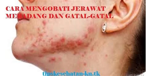 Cara Mengobati Jerawat Waras Wiris