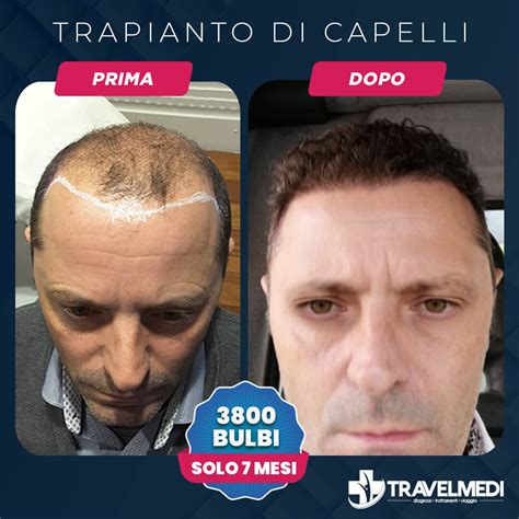 Trapianto Di Capelli Dhi Prezzi Prima E Dopo