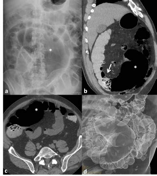 Cecal Volvulus Xray