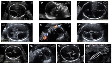 Ultrasonic Findings Of The Three Cases A Fetal Ultrasound Examination