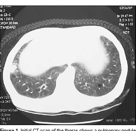 Figure 1 From Lymphoepithelioma Like Carcinoma Of The Lung Semantic