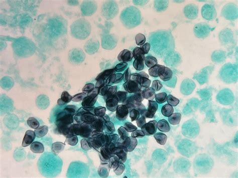 Pneumocystis Jirovecii On Gms Stain Most Common Fungal Infection Pneumonia Pjp In Hivaids