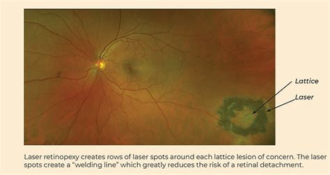 Lattice Degeneration Bay Area Retina Associates