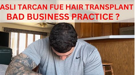 Asli Tarcan Fue Hair Transplant Results My Only Problem With Asli