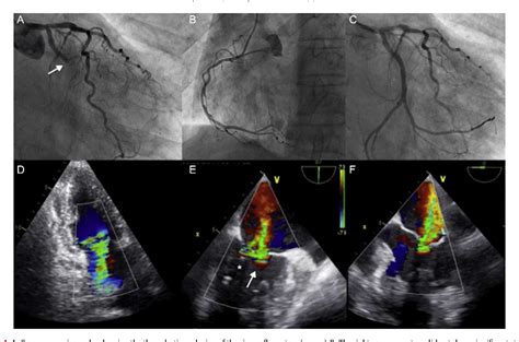 Figure 1 From Percutaneous Mitral Valve Repair With Mitraclip System