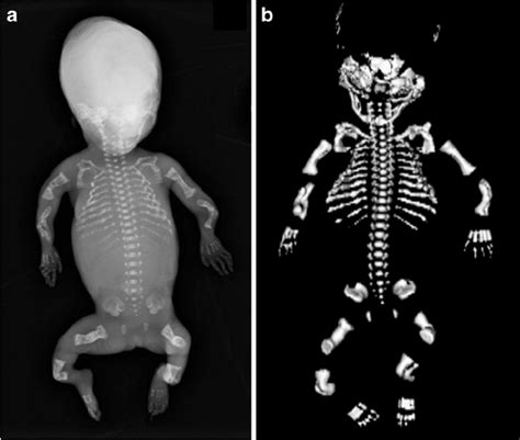 Postmortem Skeletal Radiograph A And D Postmortem Ct